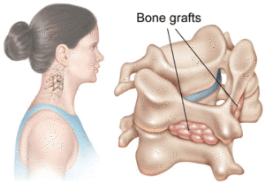 bone grafts