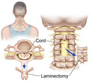 spinal stenosis surgery