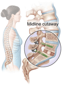 lumbar fusion