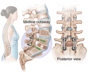 posterior spinal fusion