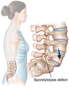 spondylolysis