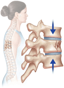 compression fracture
